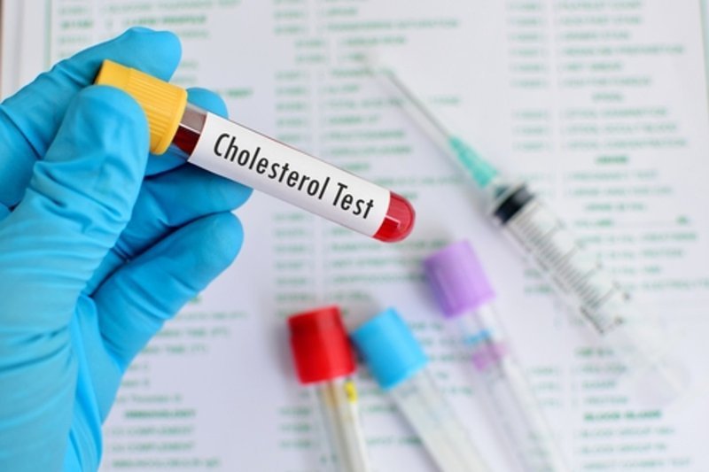 Lưu ý khi thực hiện xét nghiệm cholesterol toàn phần